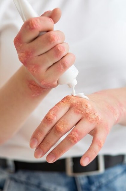 Jak vzniká atopický ekzém